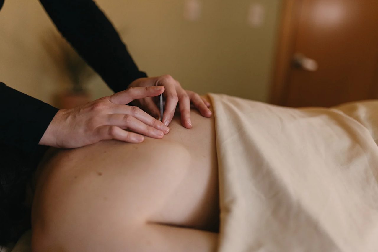 An acupuncturist inserts a needle near a patient's lower back, the patient draped in a cream sheet.